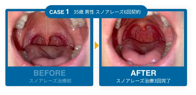 CASE1 before after