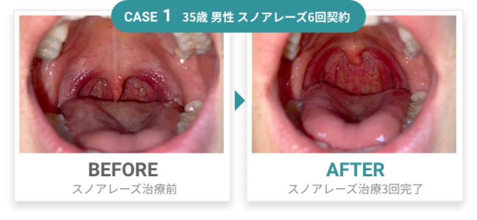 CASE1 before after