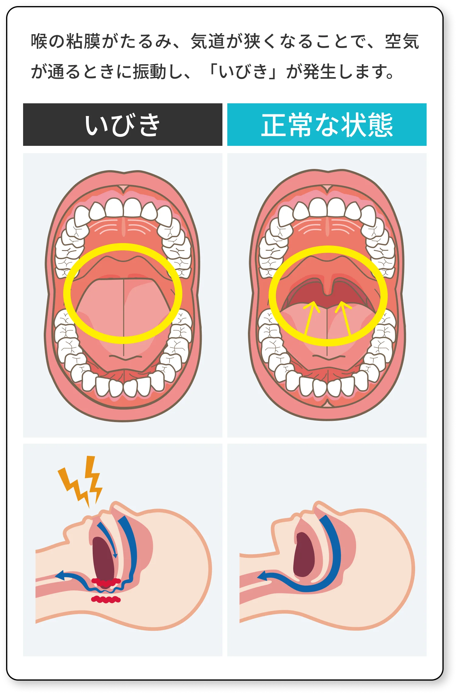 喉の粘膜がたるみ、気道が狭くなることで