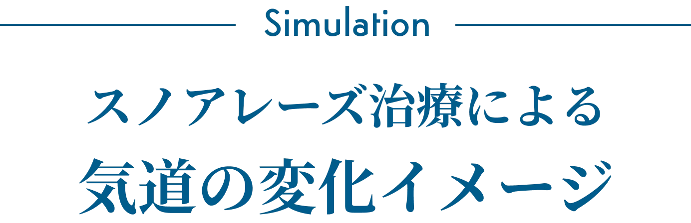 スノアレーズ治療による気道の変化イメージ
