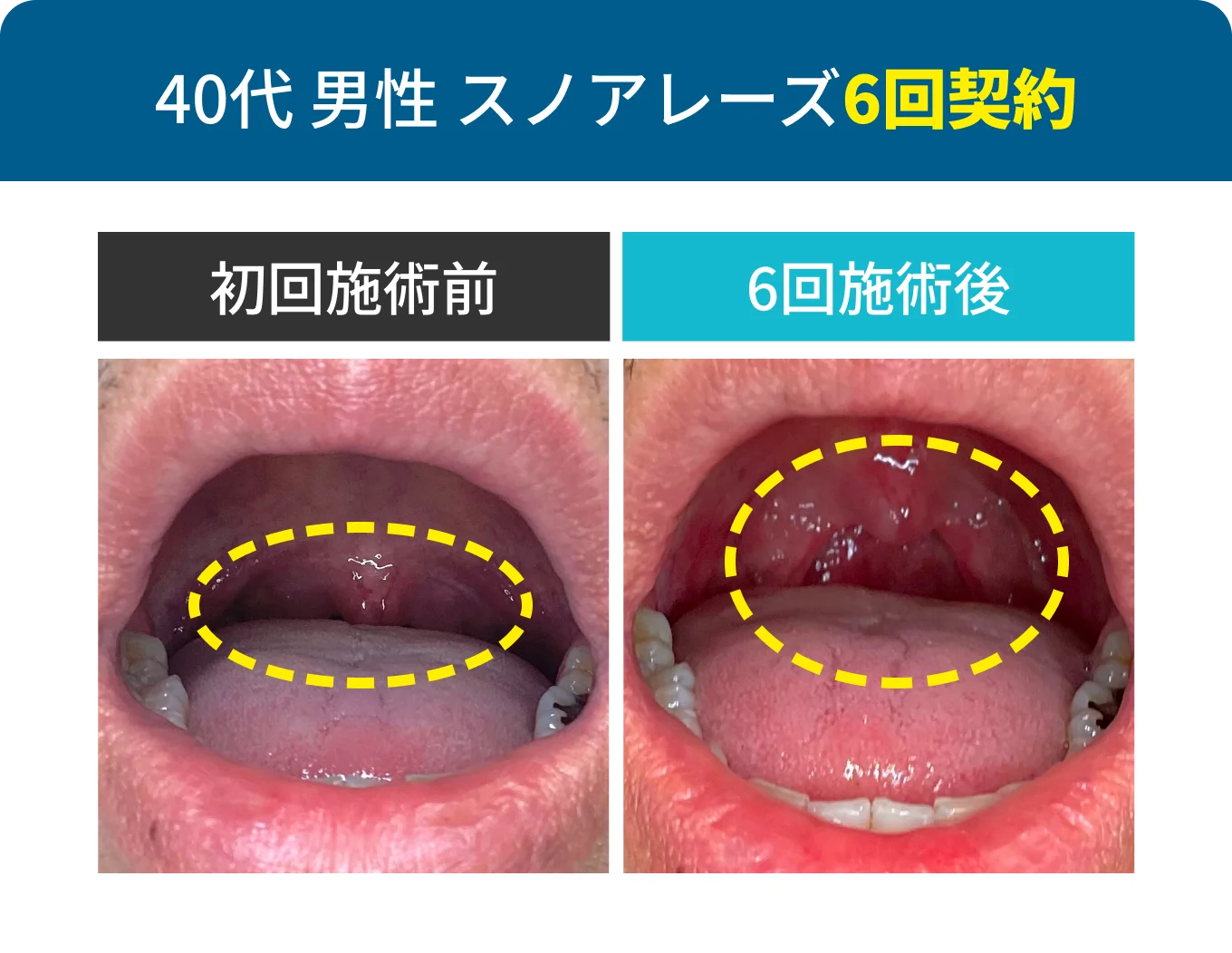 40代男性スノアレーズ6回契約
