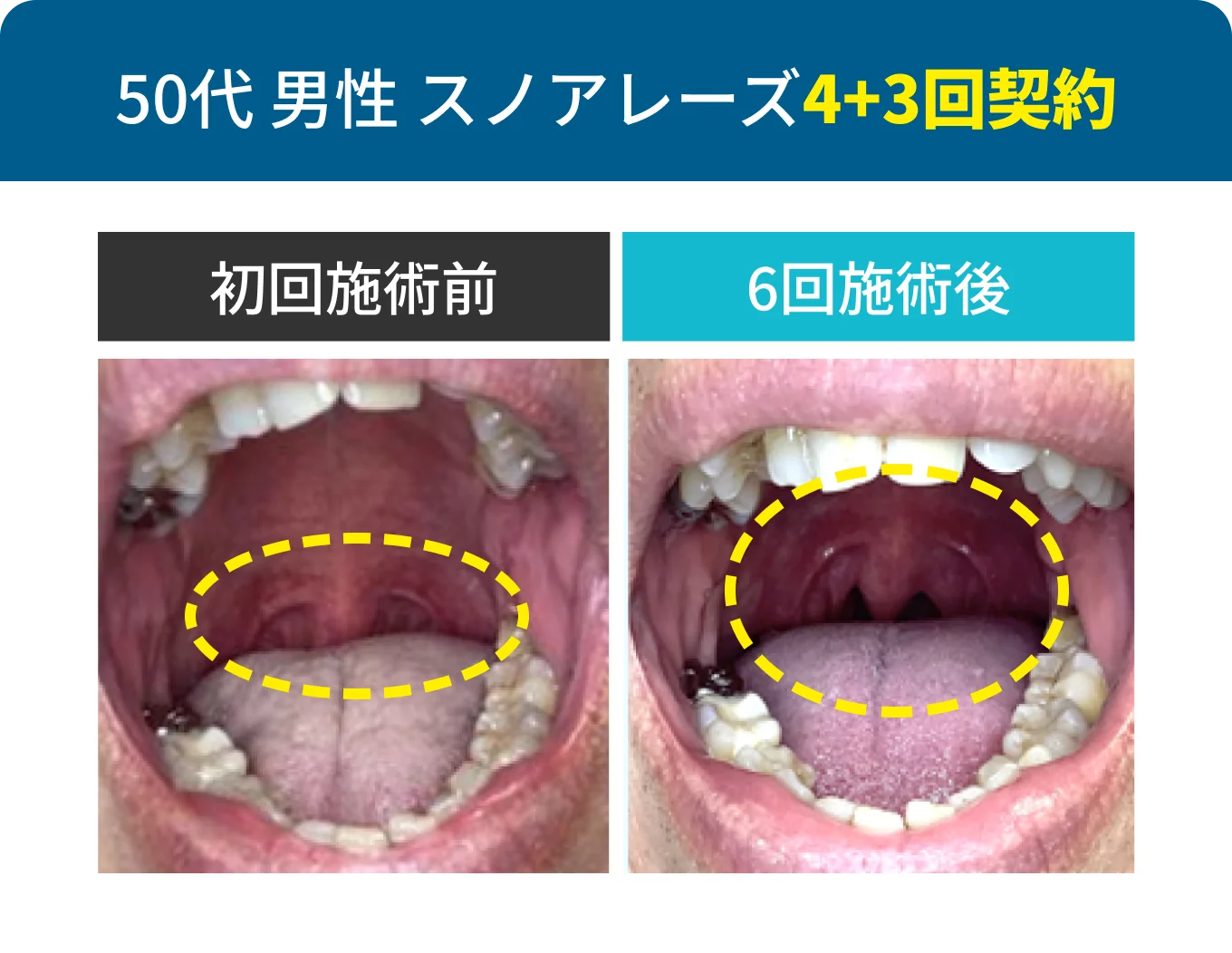 50代 男性 スノアレーズ4+3回契約