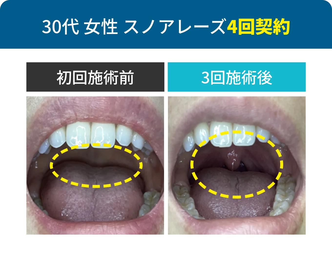 30代 女性 スノアレーズ4回契約