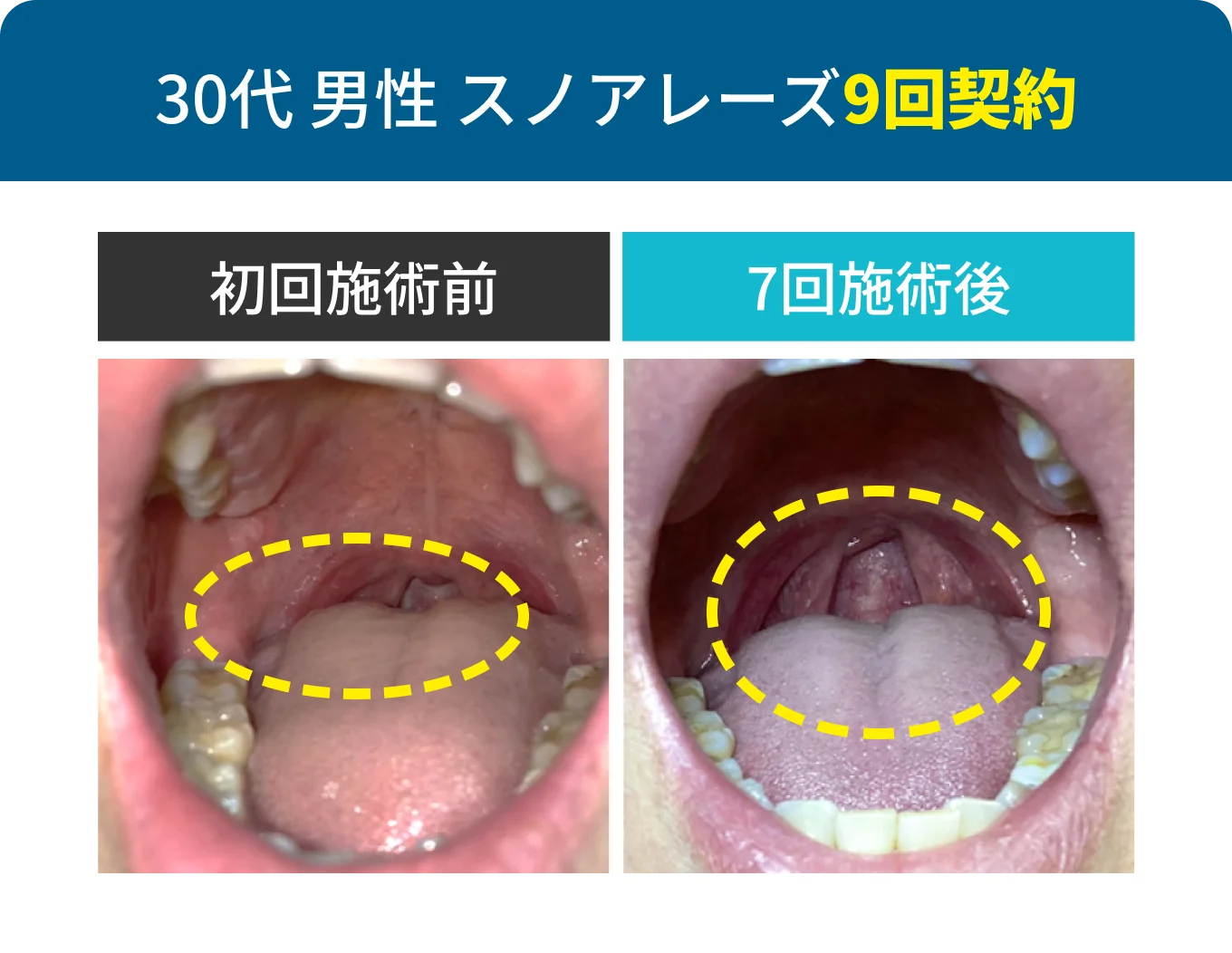 30代 男性 スノアレーズ9回契約
