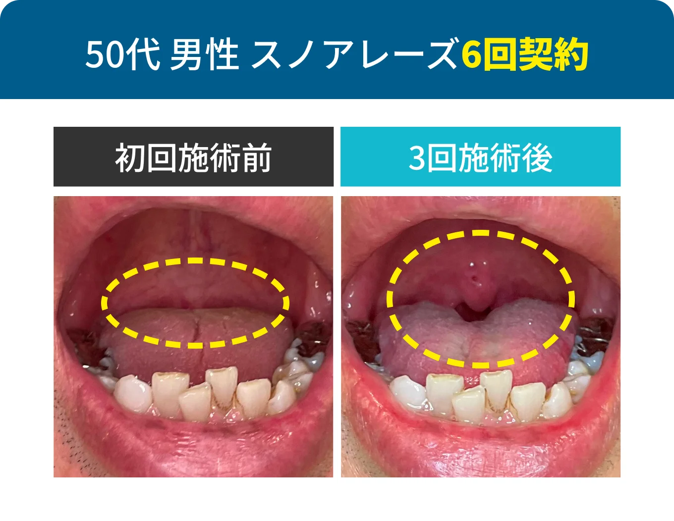 50代 男性 スノアレーズ6回契約