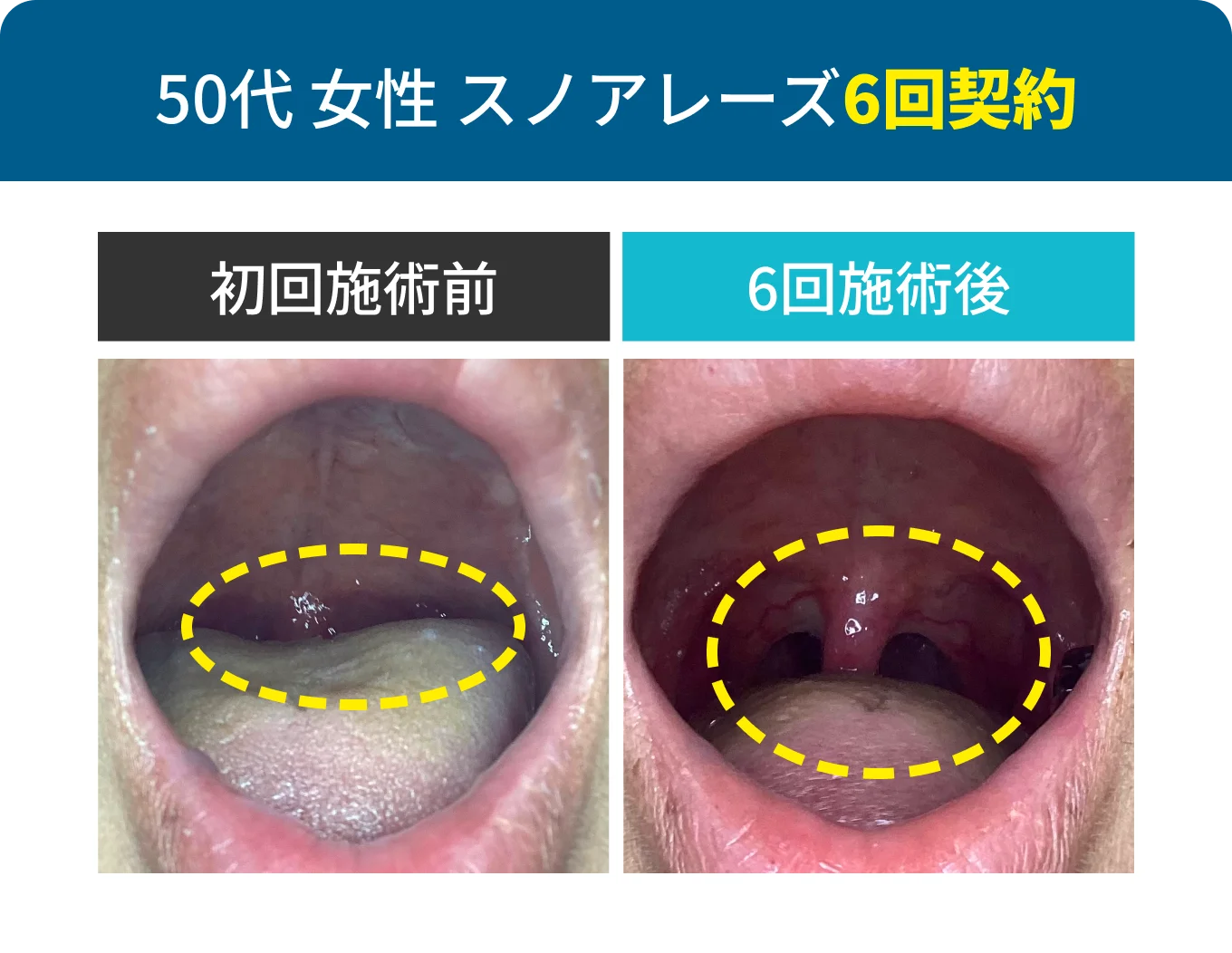 50代 女性 スノアレーズ6回契約