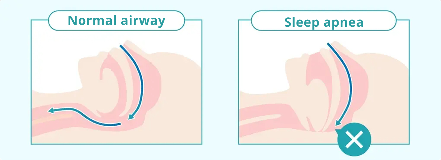 Normal airway vs. sleep apnea airway