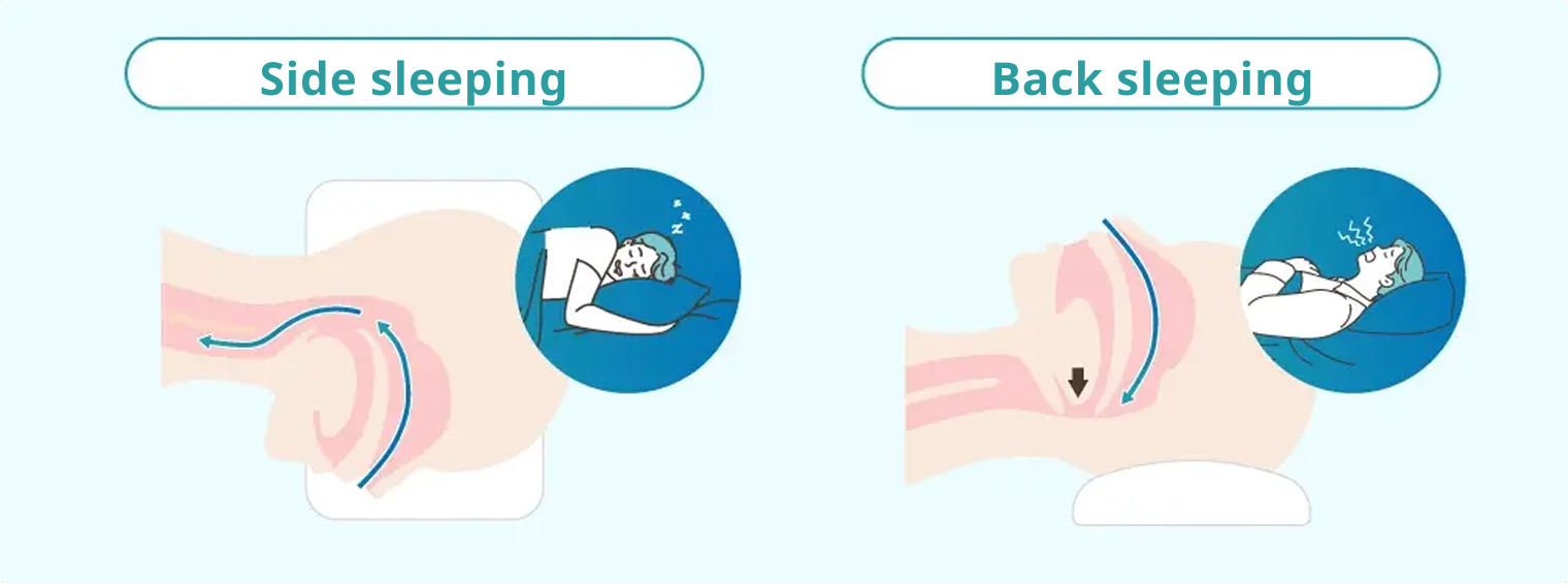Airway difference between side and back sleeping