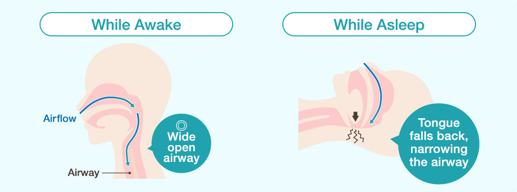 Airway during normal and sleep states