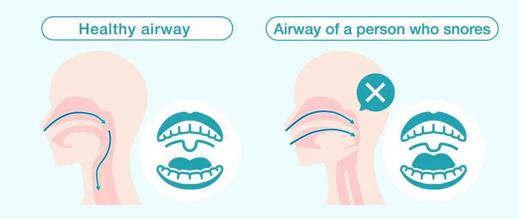 Causes of Snoring