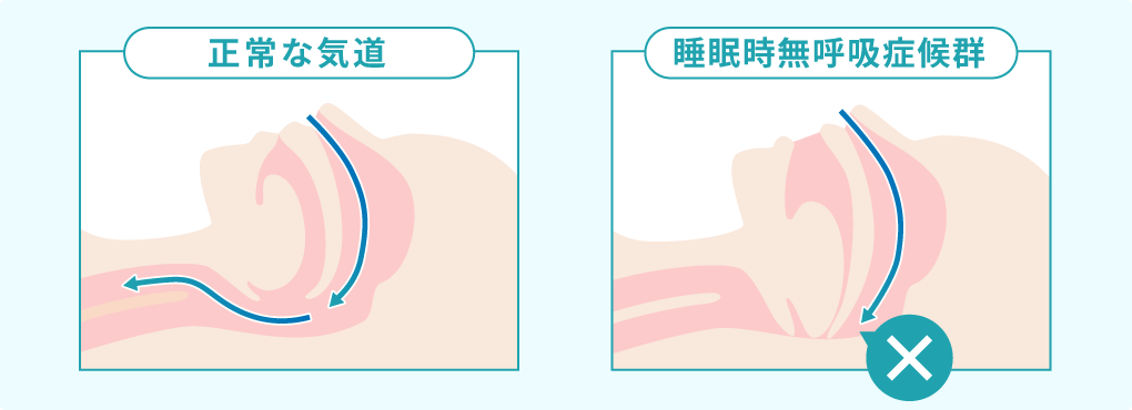 正常な気道と睡眠時無呼吸症候群の気道