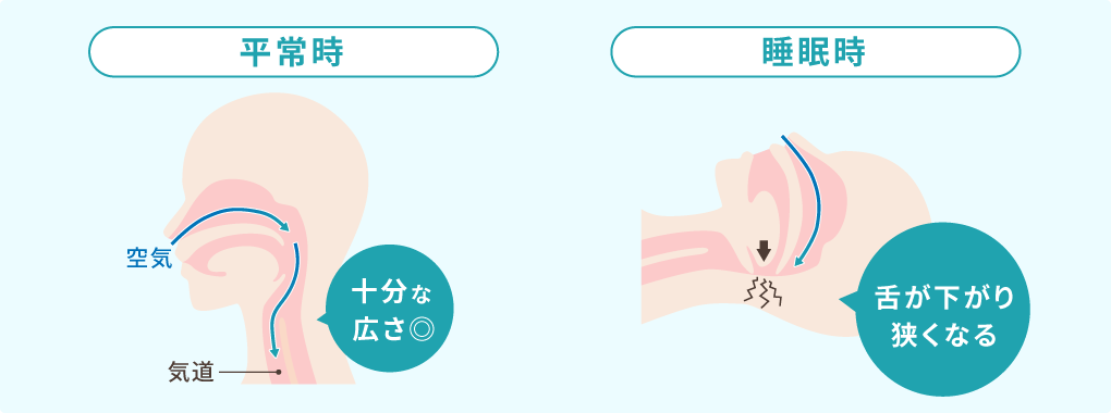平常時と睡眠時の気道の様子