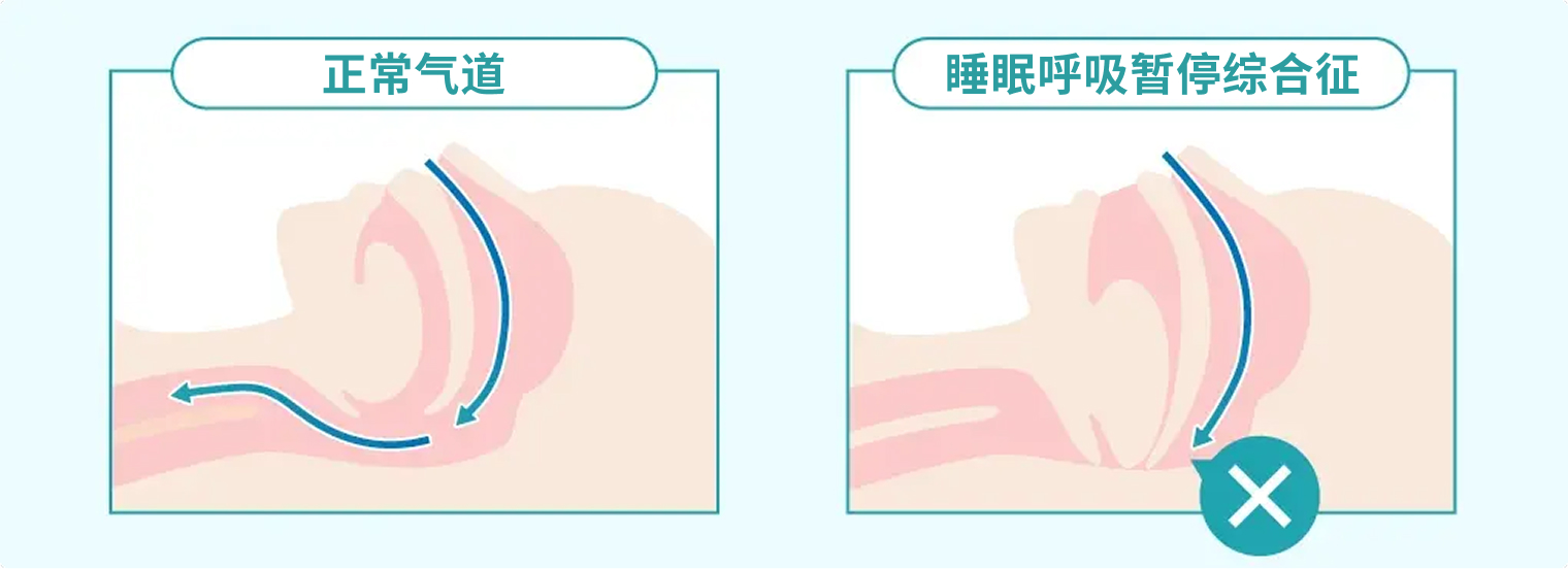 正常气道与睡眠呼吸暂停综合征气道对比