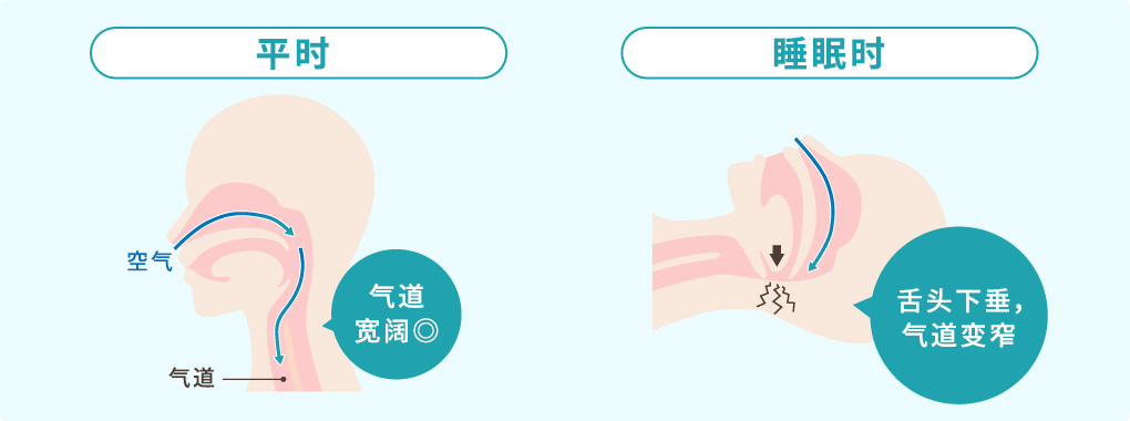 正常状态与睡眠时气道对比