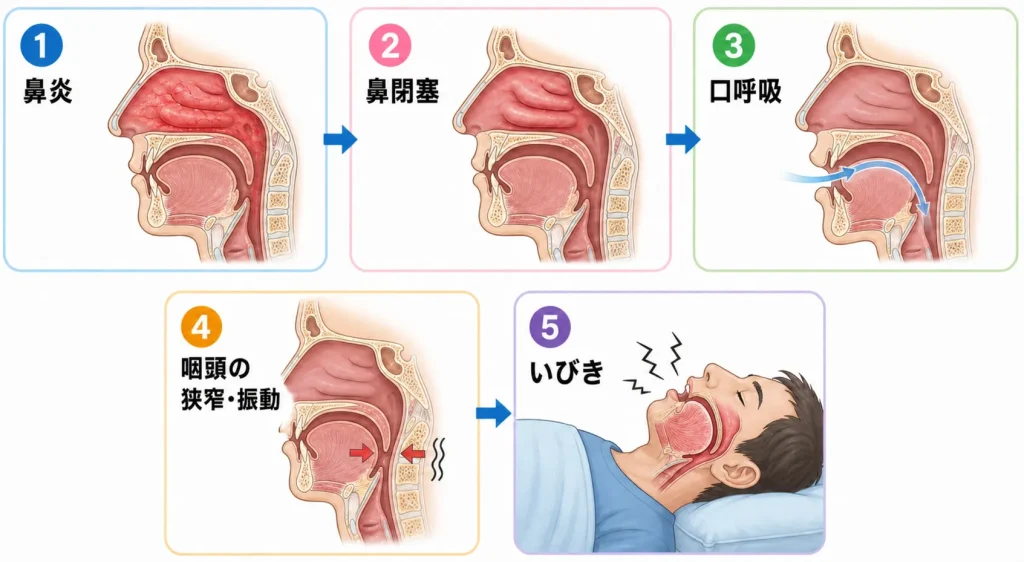 「鼻炎&rarr;鼻閉塞&rarr;口呼吸&rarr;喉の振動&rarr;いびき」の矢印図の図解イラスト