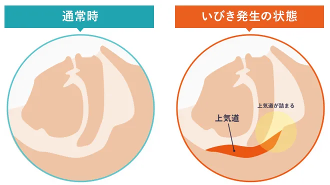 いびきが発生する理由とメカニズムのイラスト