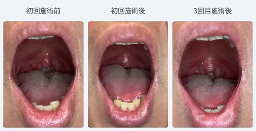 スノアレーズ3回の治療を受けた40代男性の口腔内比較写真(初回施術前・初回施術後・3回目施術後)