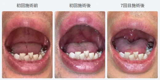 スノアレーズ6回+追加1回の治療を受けた50代男性の口腔内比較写真(初回施術前・初回施術後・7回目施術後)