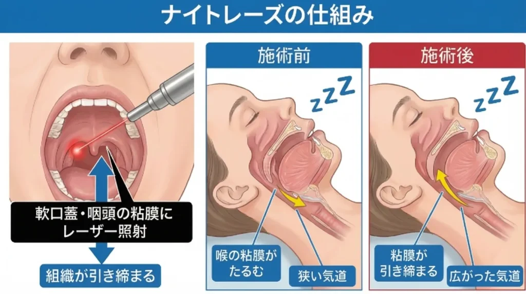 ナイトレーズの仕組みを示す図。レーザーを軟口蓋や咽頭の粘膜に照射し、組織が引き締まることで気道が広がり、いびきが軽減される様子。