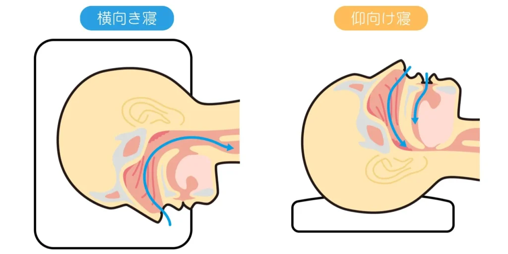 横向き寝と仰向け寝の違いを示した図解。仰向け寝では舌が喉の奥に落ち込み気道がふさがれやすく、横向き寝では気道が確保され、いびきや睡眠時無呼吸が起こりにくいことを示している。