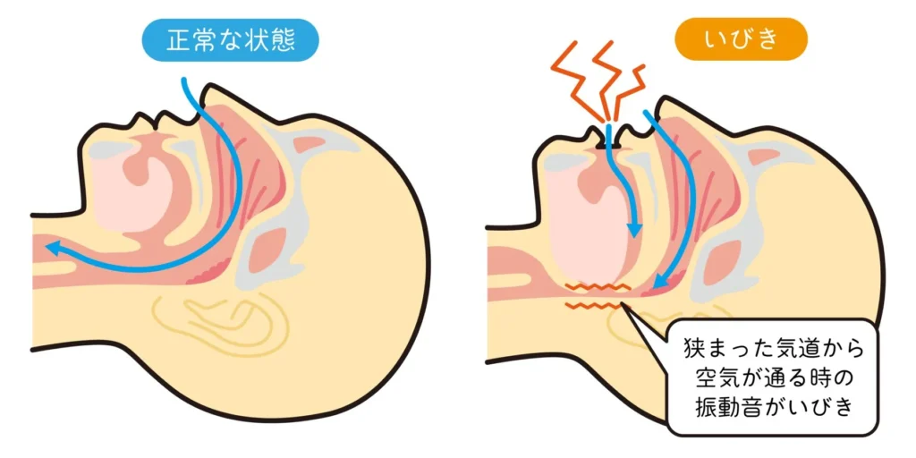 疲れによって喉の筋肉が緩み、気道が狭くなっていびきが発生するメカニズムを示す図解