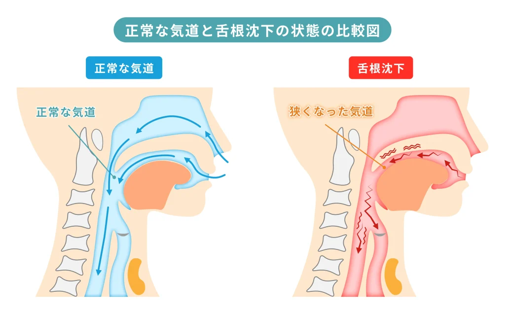 正常な気道と舌根沈下の状態を比較した図。舌の位置により気道が確保されている状態と、舌根が喉の奥に落ち込み気道が狭くなる状態を示している。