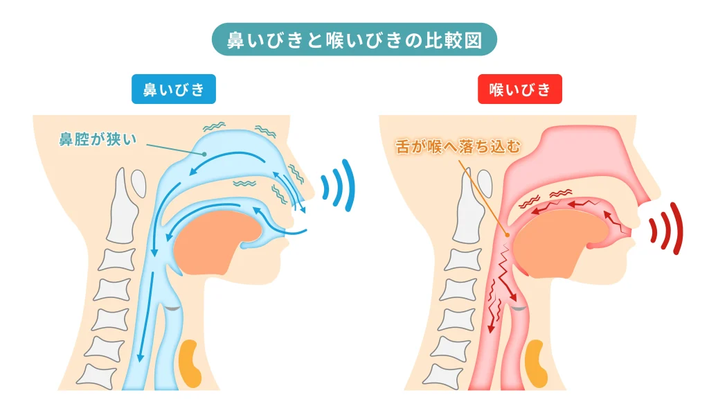 鼻いびきと喉いびきの違いを示した比較図。鼻腔が狭くなって起こる鼻いびきと、舌が喉へ落ち込んで気道が狭くなる喉いびきの仕組みを説明している。