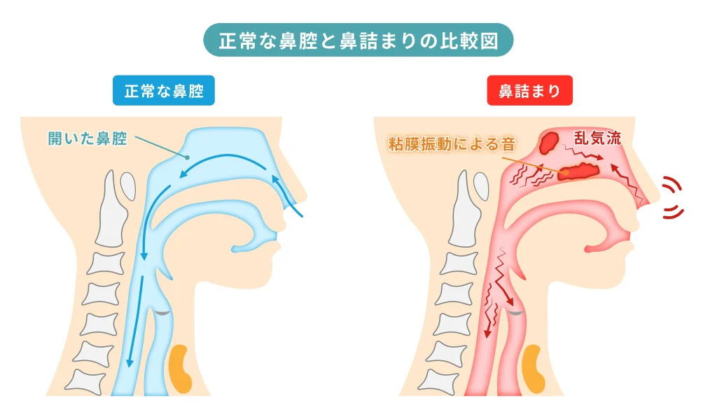 正常な鼻腔と鼻詰まりの状態を比較した図。鼻腔内の粘膜が腫れて気流が乱れ、粘膜が振動して音が出る仕組みを示している。
