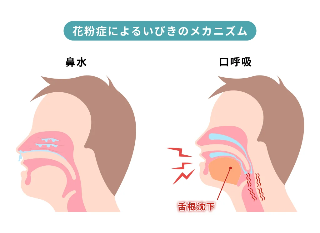 花粉症による鼻づまりから口呼吸になり、舌根沈下といびきが起こる仕組みを示した図解