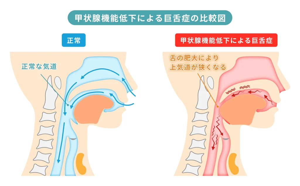 正常な状態と甲状腺機能低下症における巨大舌を比較した図解。舌の肥大により上気道が狭くなり、気道閉塞やいびき、睡眠時無呼吸の原因となる様子を示している。
