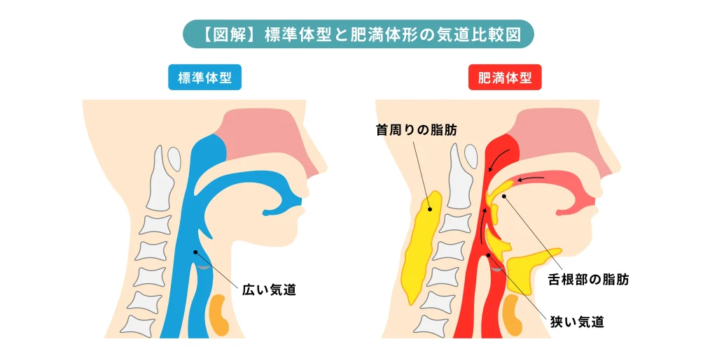 肥満体型と標準体型の気道比較図