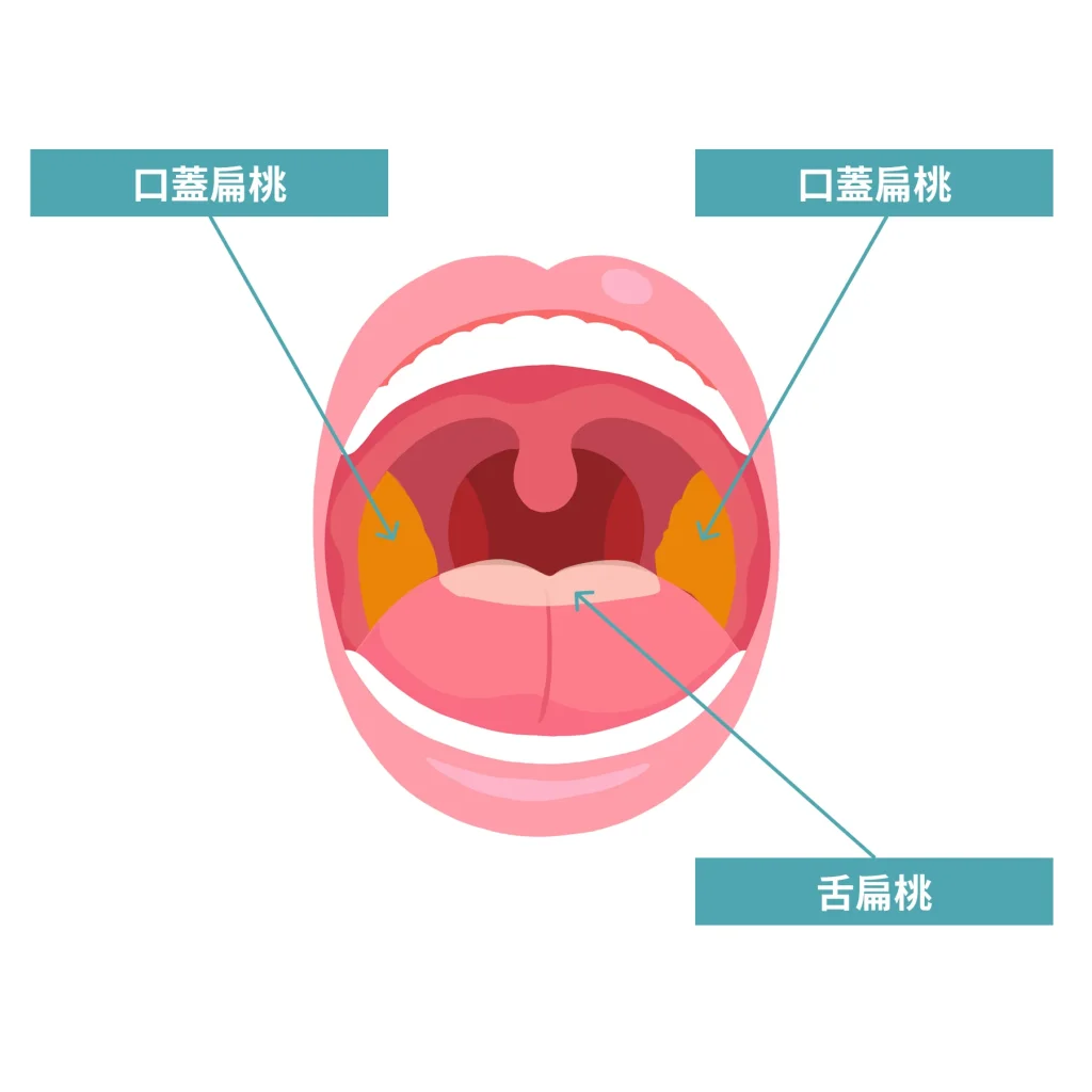 扁桃腺の位置を示す図解
