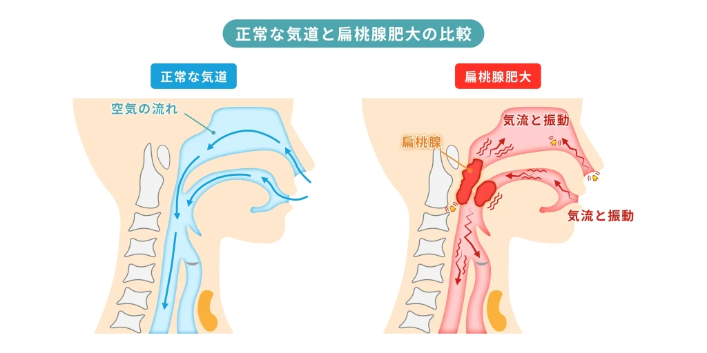 正常な気道と扁桃腺肥大の比較