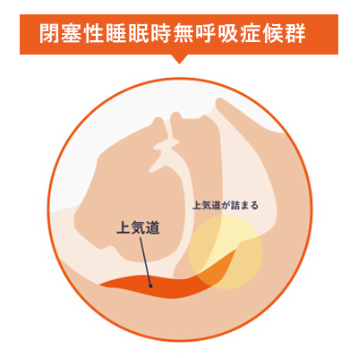 閉塞性睡眠時無呼吸症候群の特徴