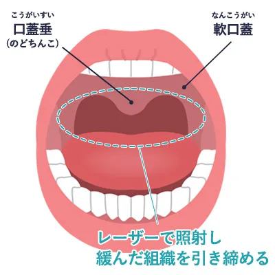 いびきレーザー治療の仕組み